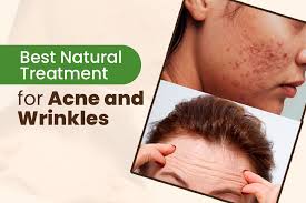 Natural Remedies for Acne, Wrinkles & Dry Skin